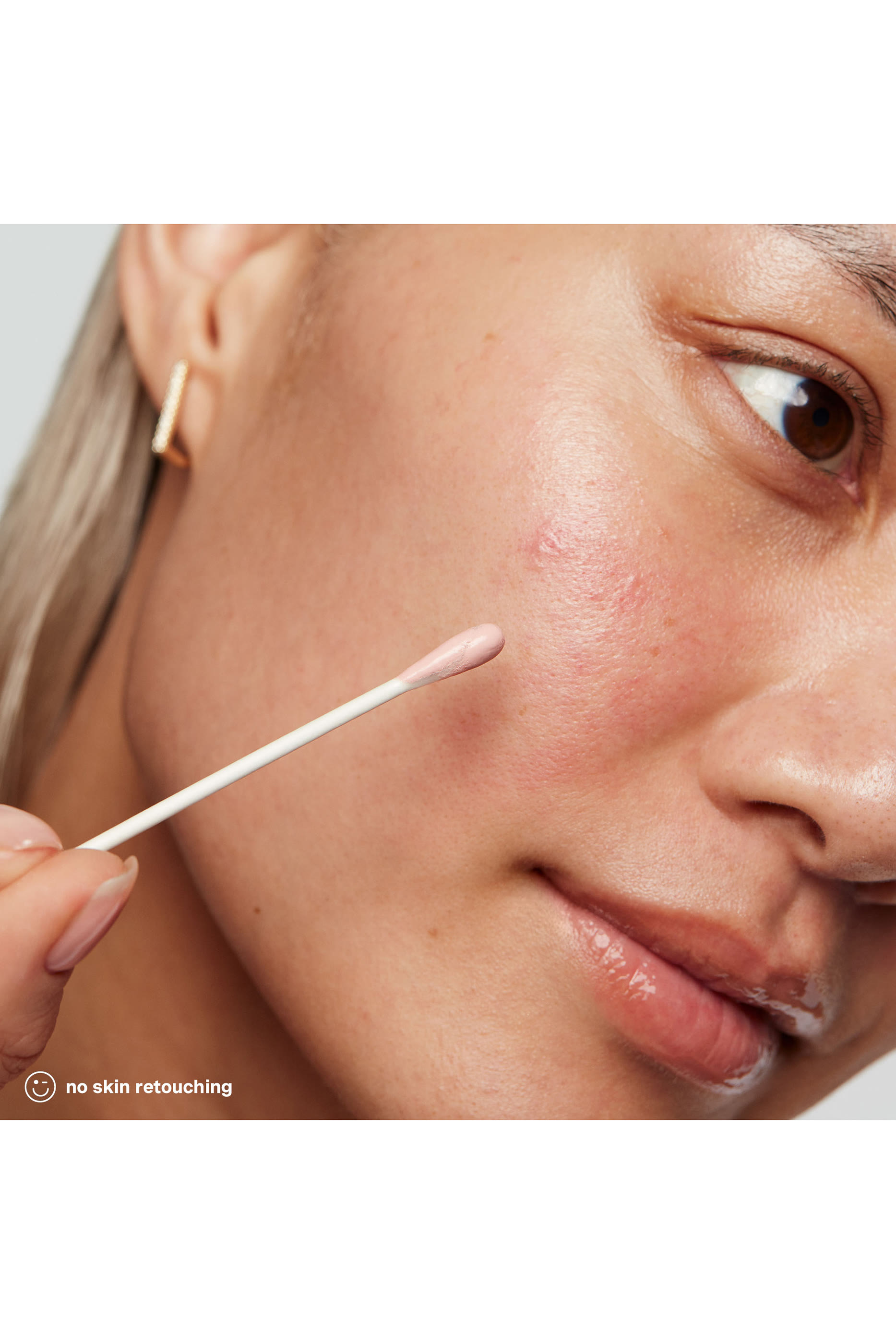 EradiKate&reg; 10% Sulfur Acne Treatment